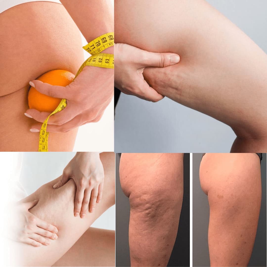 Antes después CelluLift Pro elimina celulitis resultados