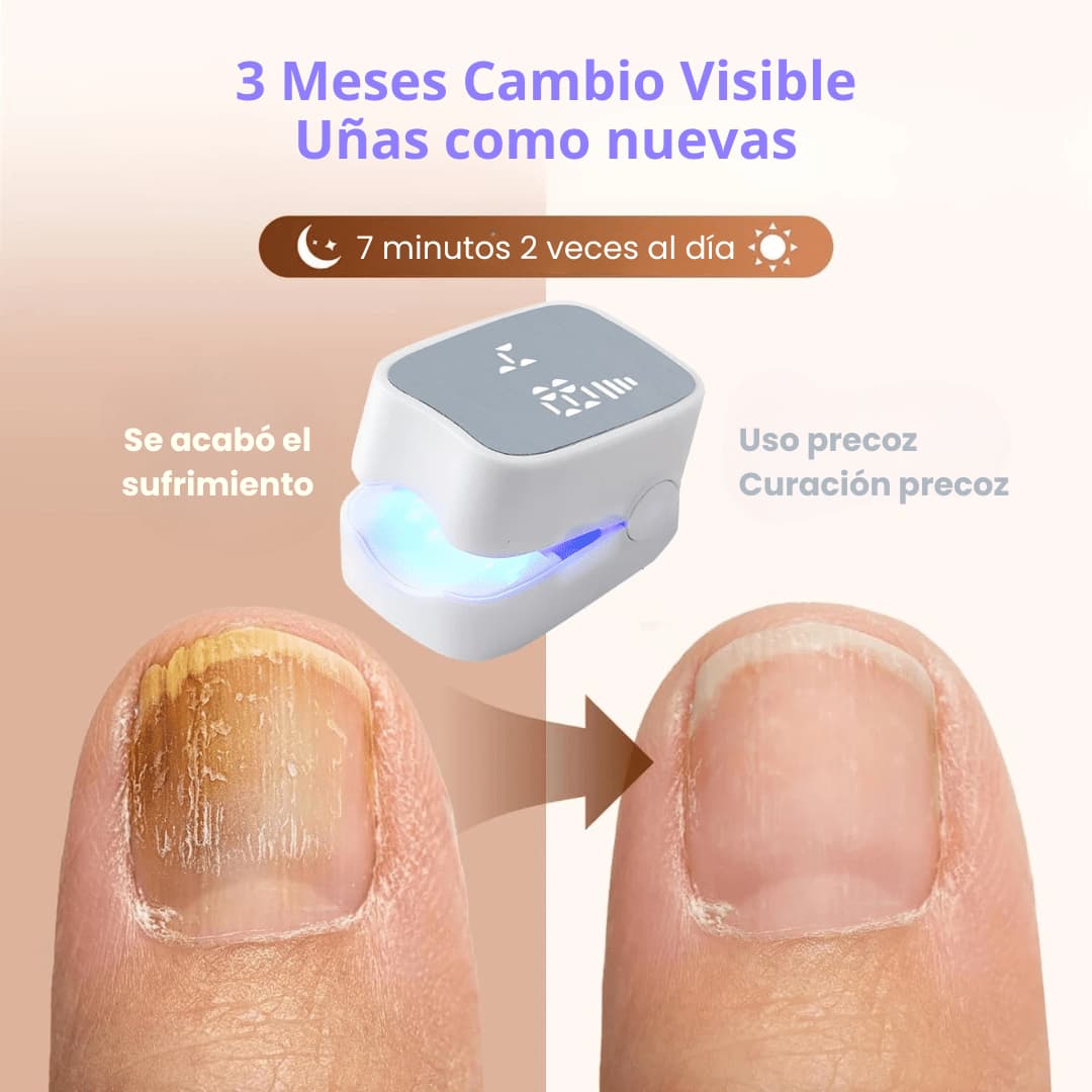 Antes y después uñas tratadas con CureNail Led