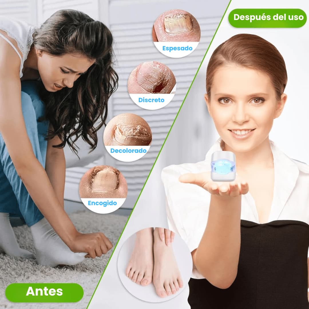 Persona usando CureNail Led en uña con hongos