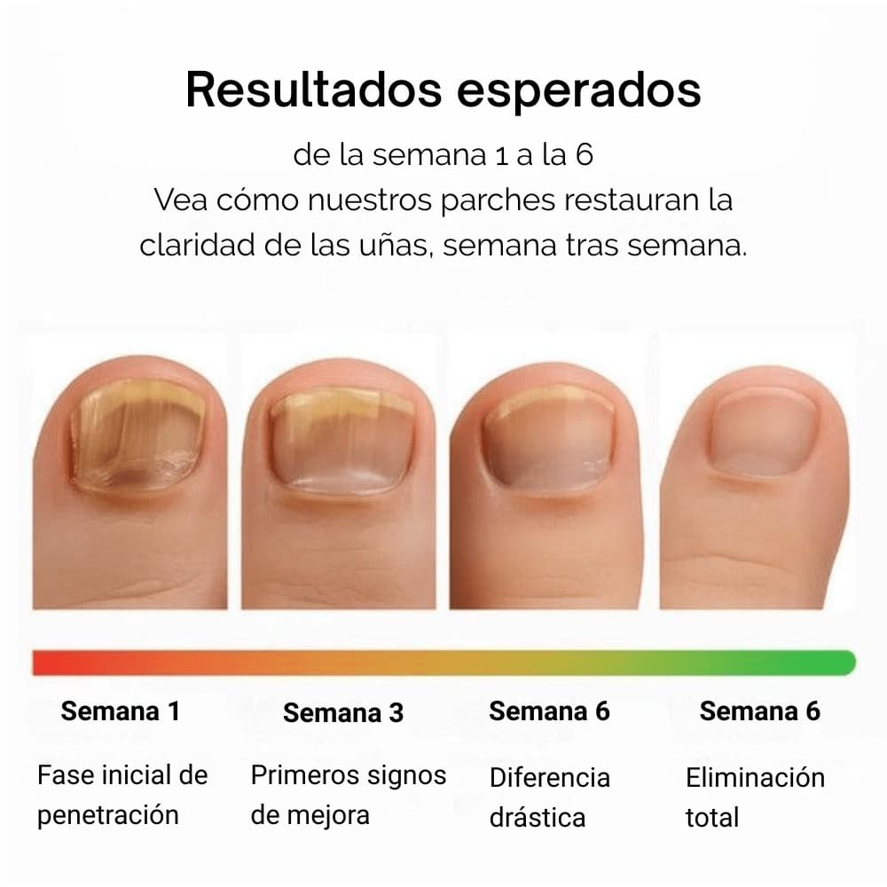 Antes después tratamiento Fungal Nail Patches uñas